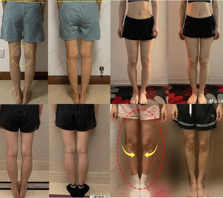 一周矫正xo型腿并瘦7cm,一周改善o型腿