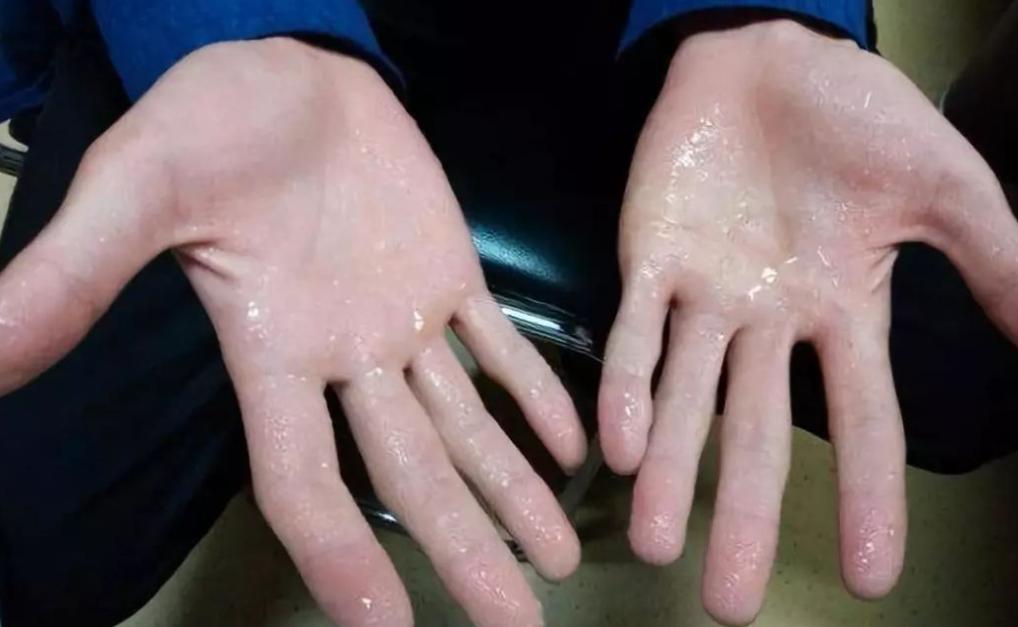 夏季这几个部位出汗要警惕,夏季出汗多可能得病了