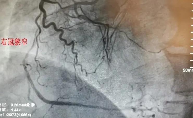 做完冠脉造影，病人就活不久了？冠脉造影检查对人体有什么危害？