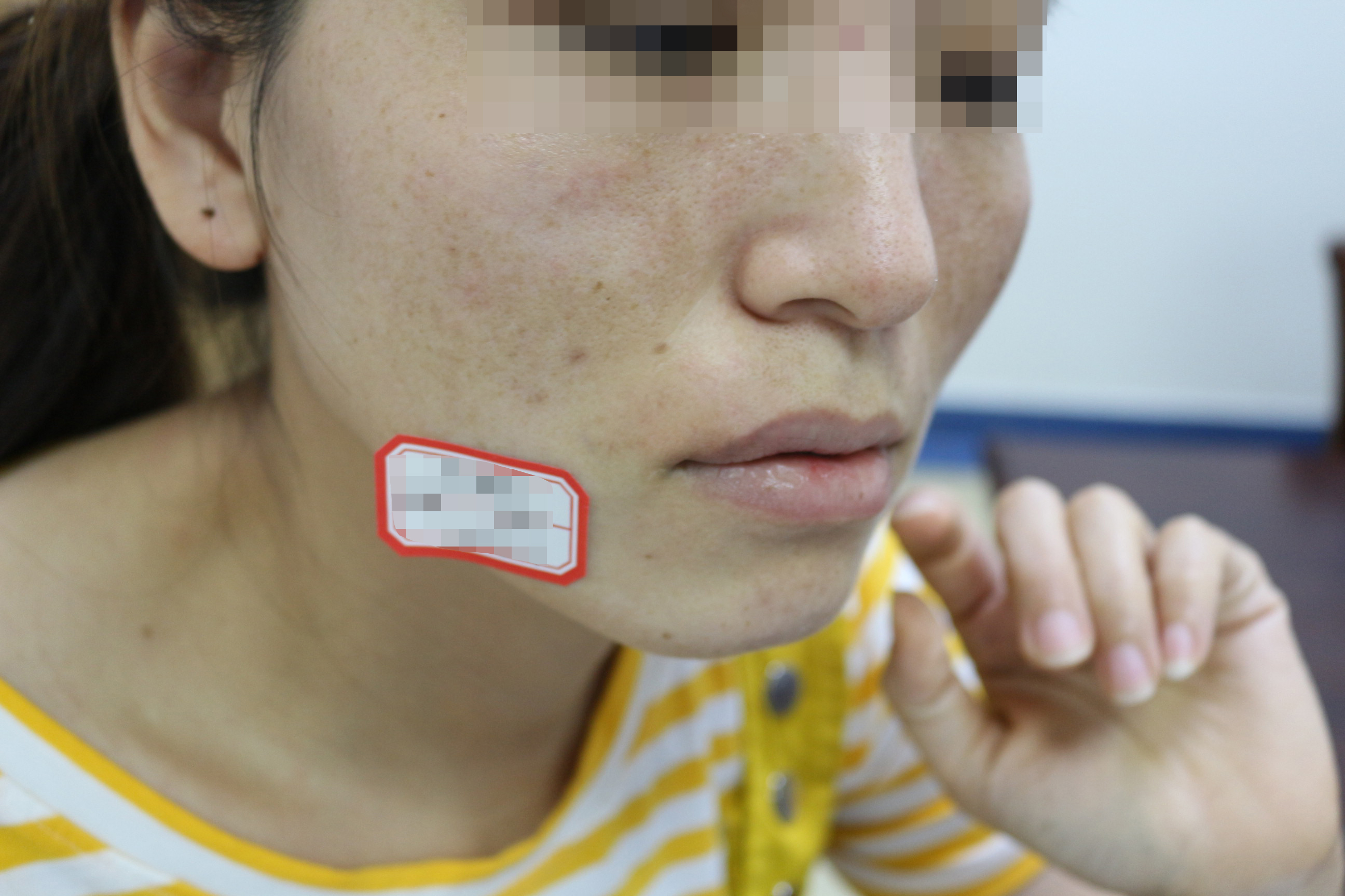 郑州哪家医院治疗凹陷疤痕,郑州疤痕医院治疗凹陷疤痕费用