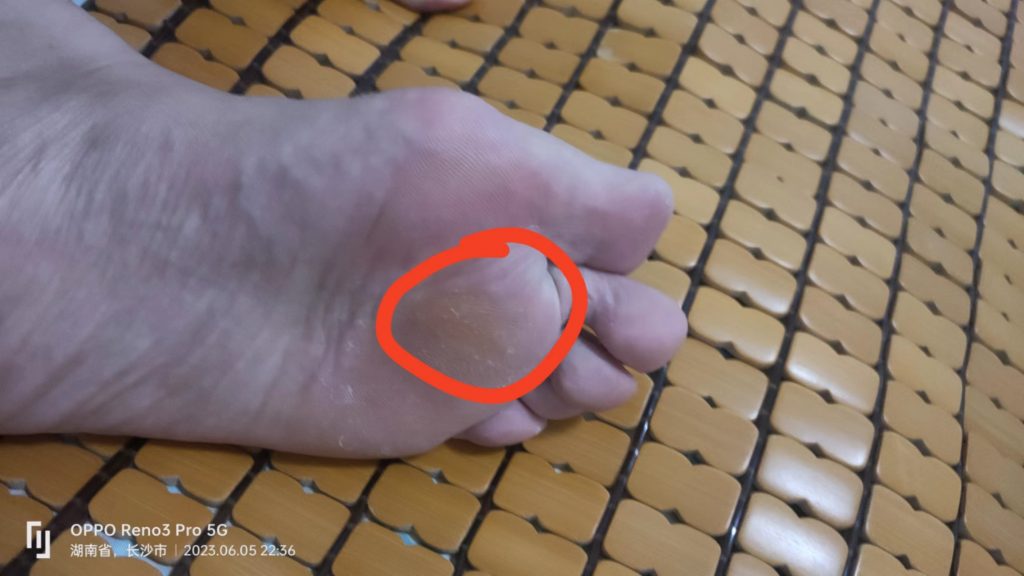 大脚骨拇指外翻后期会有什么后果,大脚骨拇外翻有什么影响