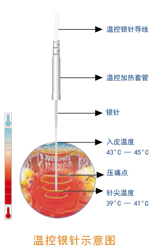 银质针和银针疗法的区别,银质针与粗银针的区别
