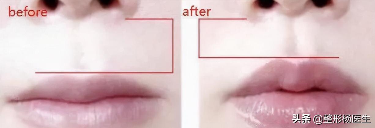 人中太长了好看吗,人中太长显老怎么办