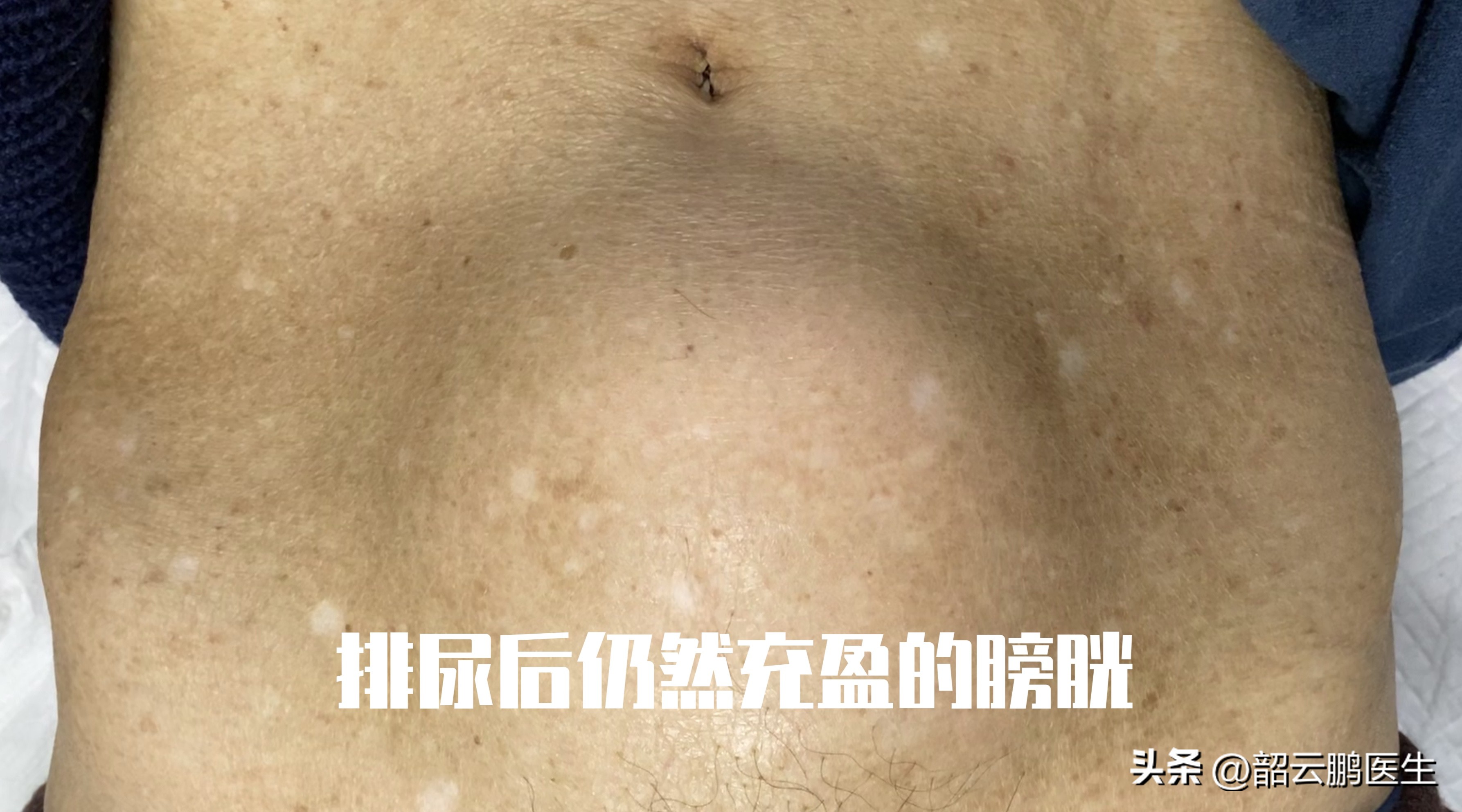 psa诊断早期前列腺癌的准确率,筛查前列腺psa需要空腹吗