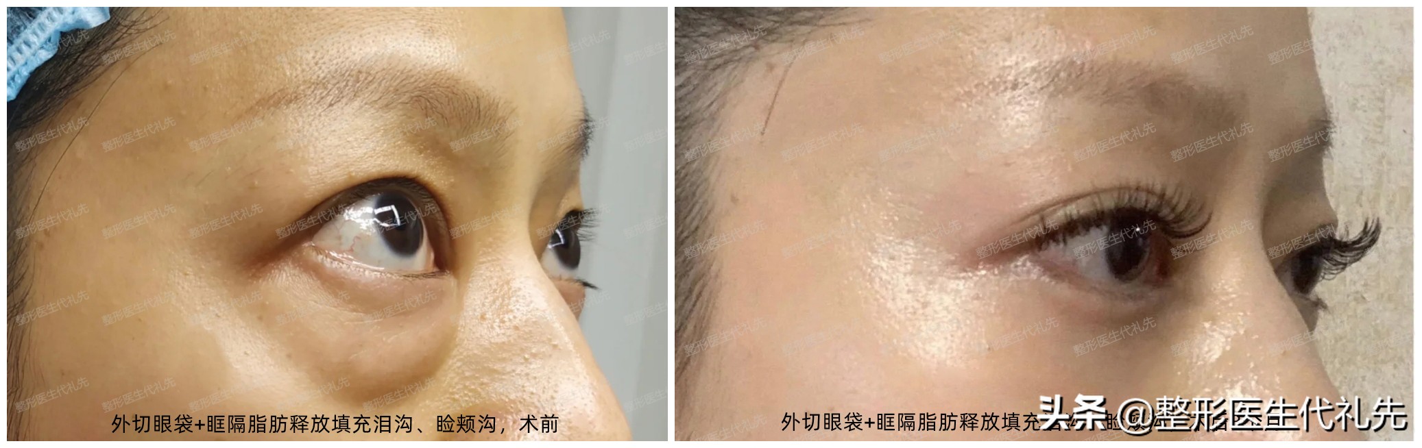 做眼袋的内切和外切的利弊,外切眼袋与内切眼袋的鉴定