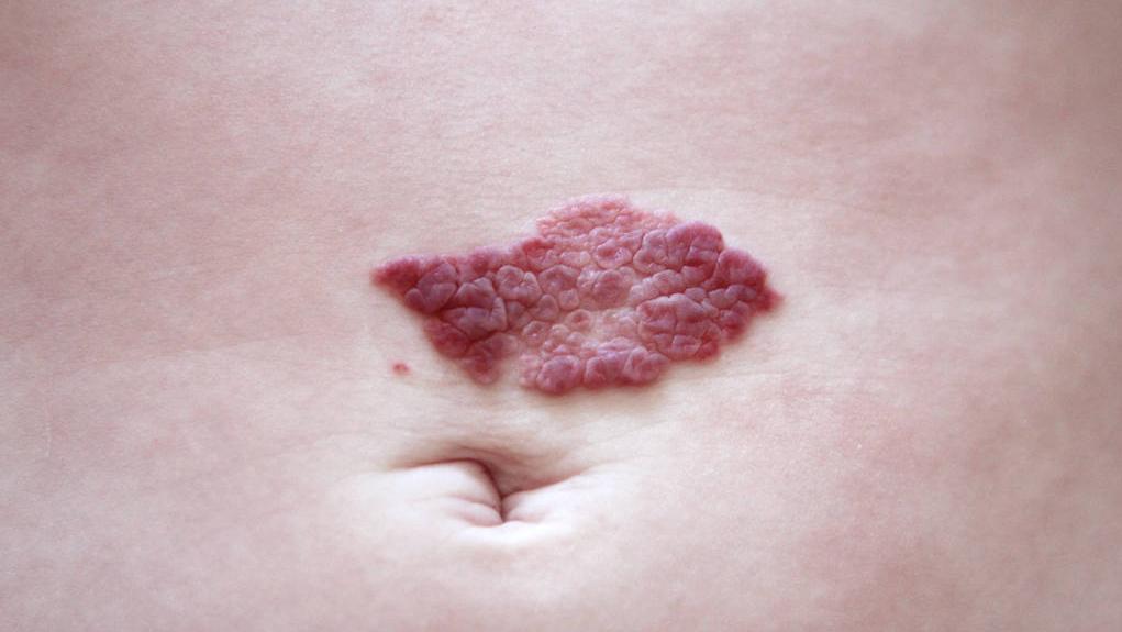 血管瘤要怎么治疗效果才最好,发现血管瘤怎么治疗好