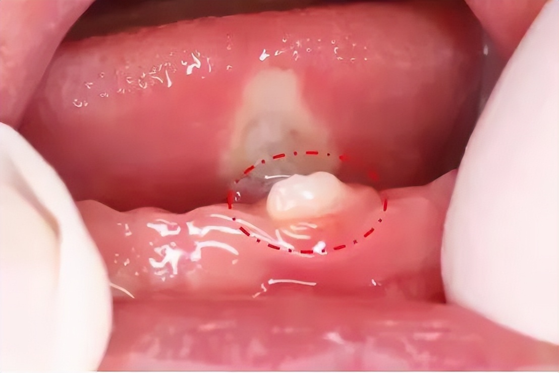 宝宝出生就有牙是什么原因,新生儿鬼牙