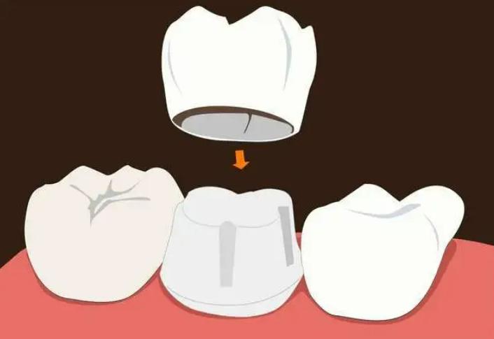 根管治疗后牙齿劈了,到底是谁的锅?专家:别把建议当回事儿