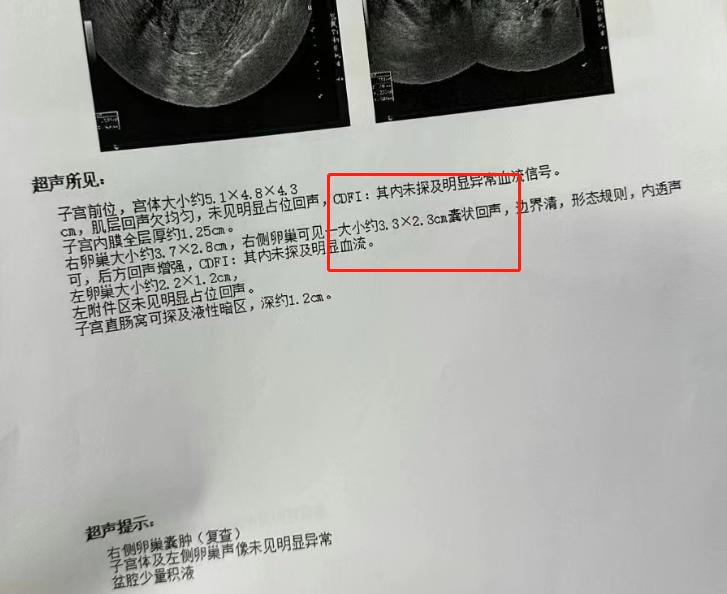 卵巢囊肿彩超查不出怎么办,卵巢囊肿ct显示无病变
