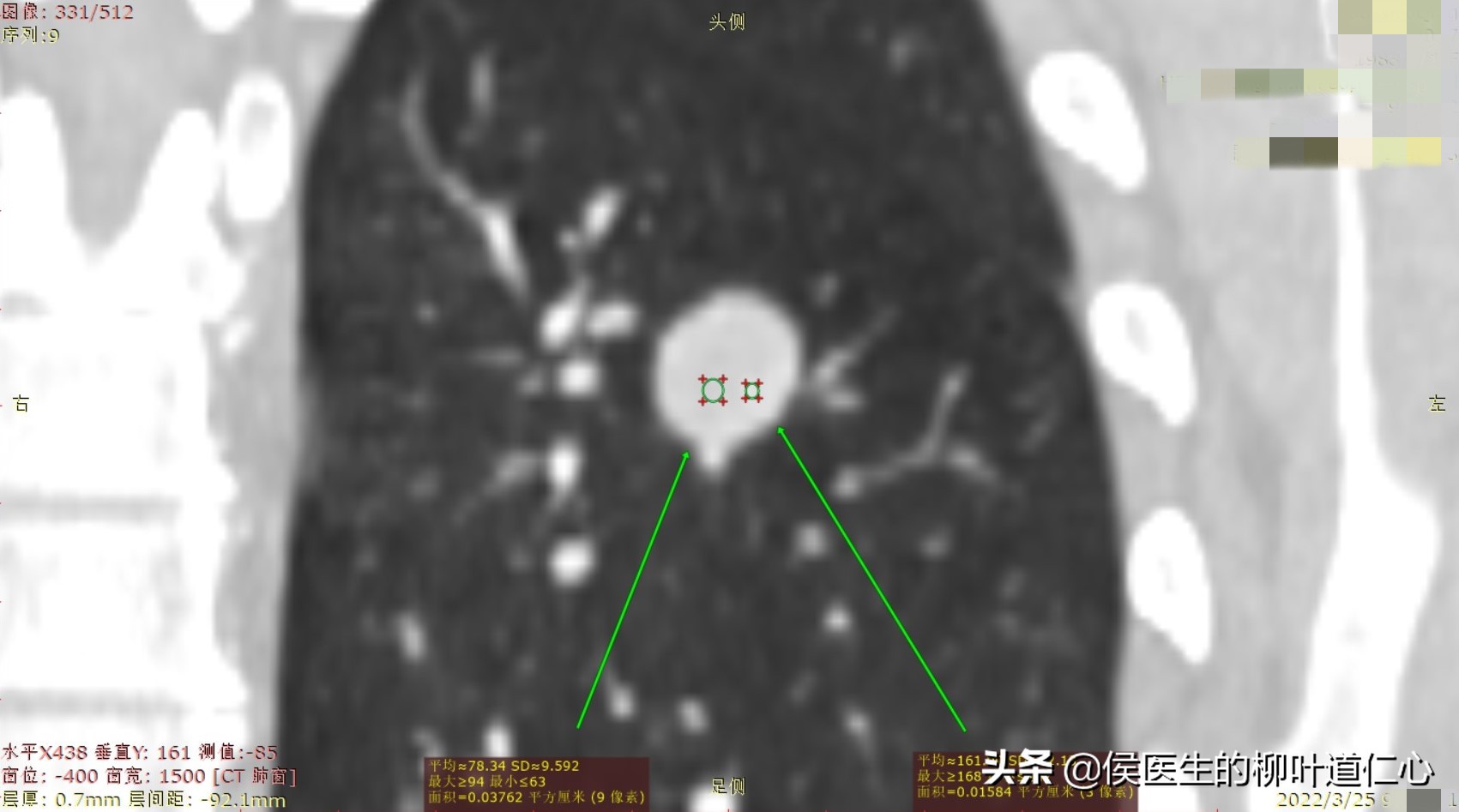 这例“被肺癌”的结节，手术不过度，但完全可以延迟在疫情后