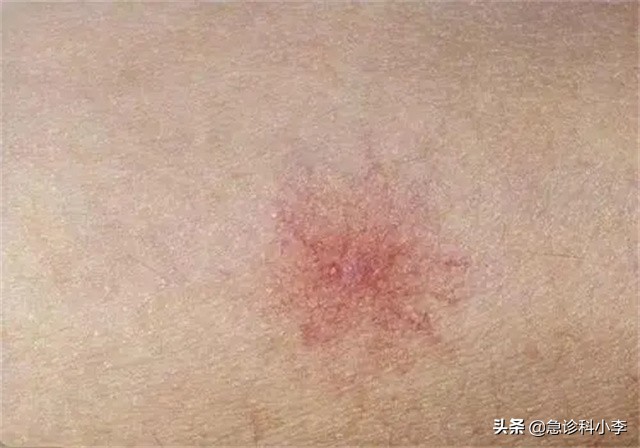 身上出现不痒的小红点是怎么回事,身上突然起了很多小红点不痛不痒