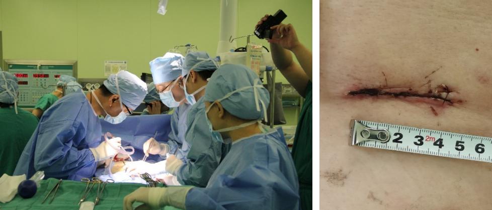 “小心尖、大作为”哈医大二院心外科微创治疗瓣膜疾病造福患者