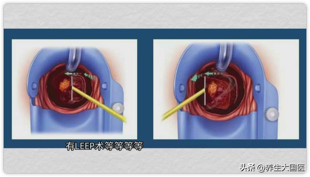 感染了hpv不及时治疗会怎样,感染hpv症状一样吗