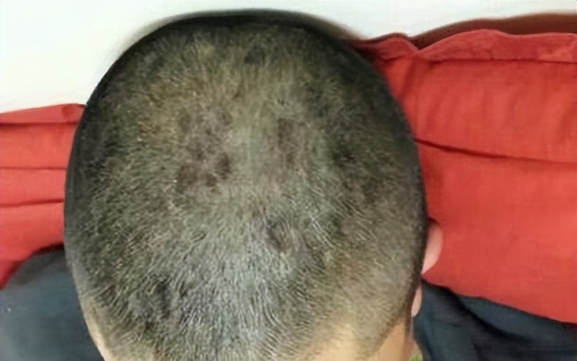 头皮上经常有疙瘩和脓包怎么回事,头皮长疙瘩脓包是什么原因