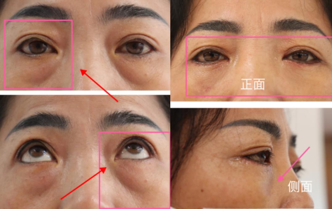 眼袋和卧蚕有没有区别,眼袋和卧蚕的区别看完你就知