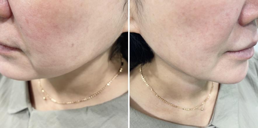 「56岁的陈女士」面部提升真实经历，术后15天效果很惊艳