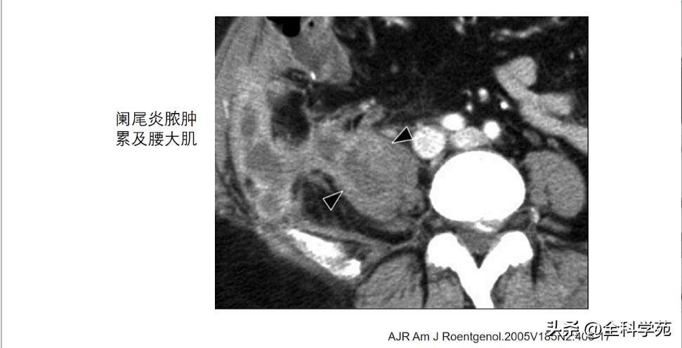阑尾炎的讲解,关于阑尾炎的讨论总结