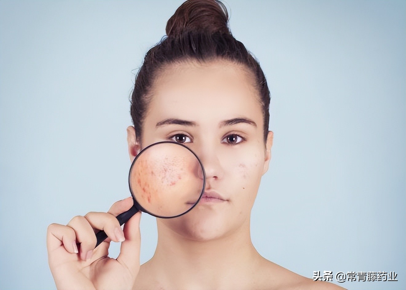 红痘印黑痘印如何快速解决,留下一大片黑红痘印怎么办