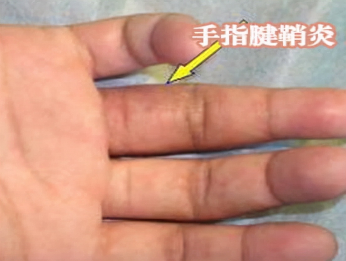 更年期女性手指腱鞘炎,女性绝经易患屈指腱鞘炎吗