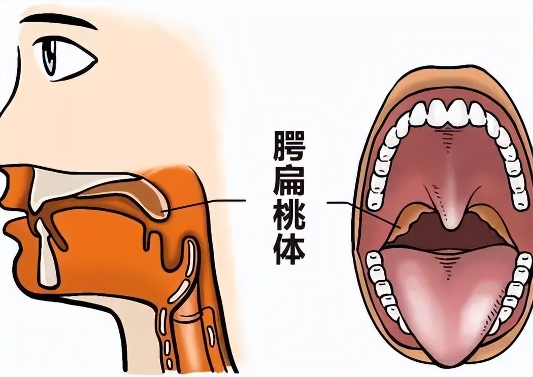 扁桃体为什么老是容易发炎,扁桃体为什么容易发炎