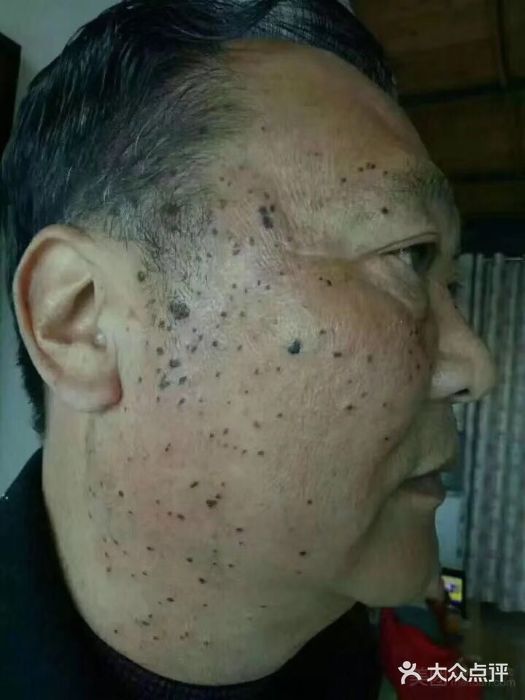 脖子上长小肉粒是不是汗斑呢,脖子上的丝状小肉粒怎么去掉