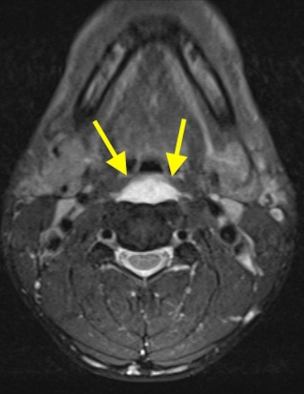 颈长肌腱炎影像表现,三头肌钙化性肌腱炎治疗