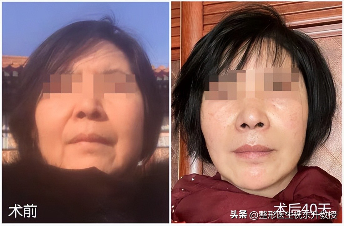 还没做“拉皮手术”，就吓得手哆嗦？可能是你想得有点多