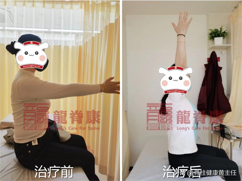 肌效贴改善肩关节半脱位使用方法,肩关节肌贴的作用