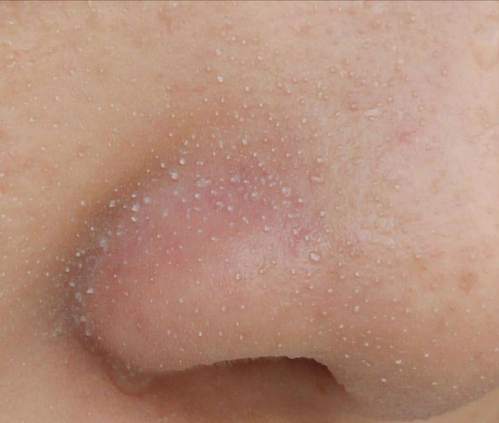 鼻子上有黑点怎么抠掉,鼻子边缘的小白点怎么去除