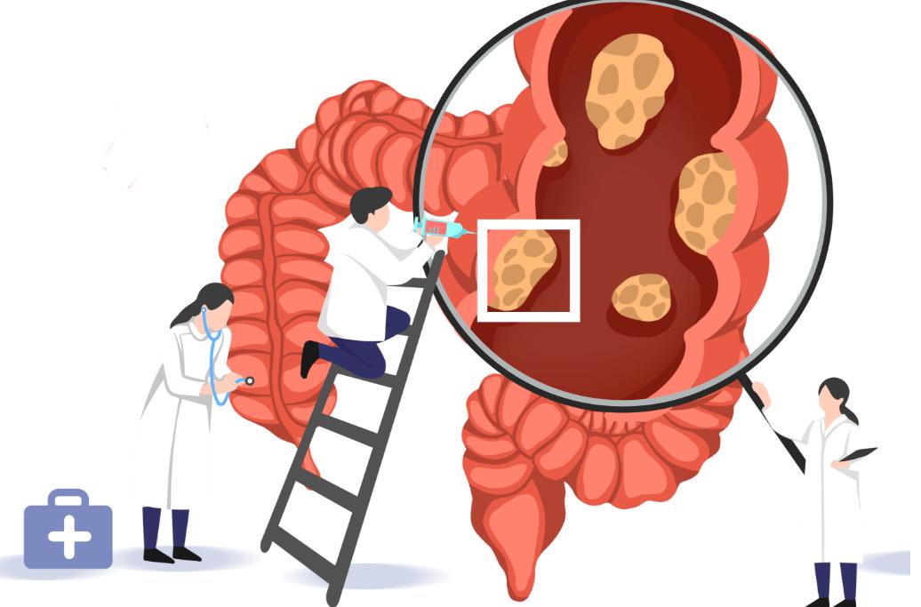 排出的大便是小球似的怎么回事,大便粪球是肠癌的征兆吗