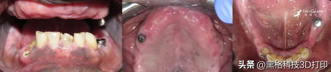 病例分享|美国BDG诊所实现全口即刻修复病例一则