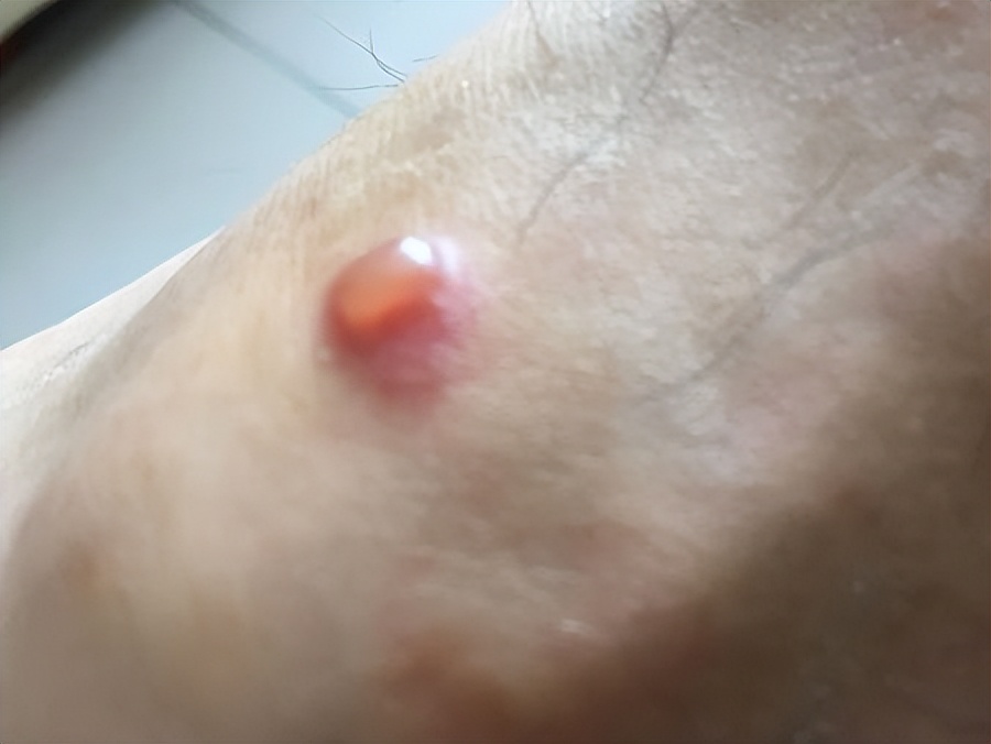 蚊子叮咬后留下的黑印如何清除？巨简单！赶快学起来