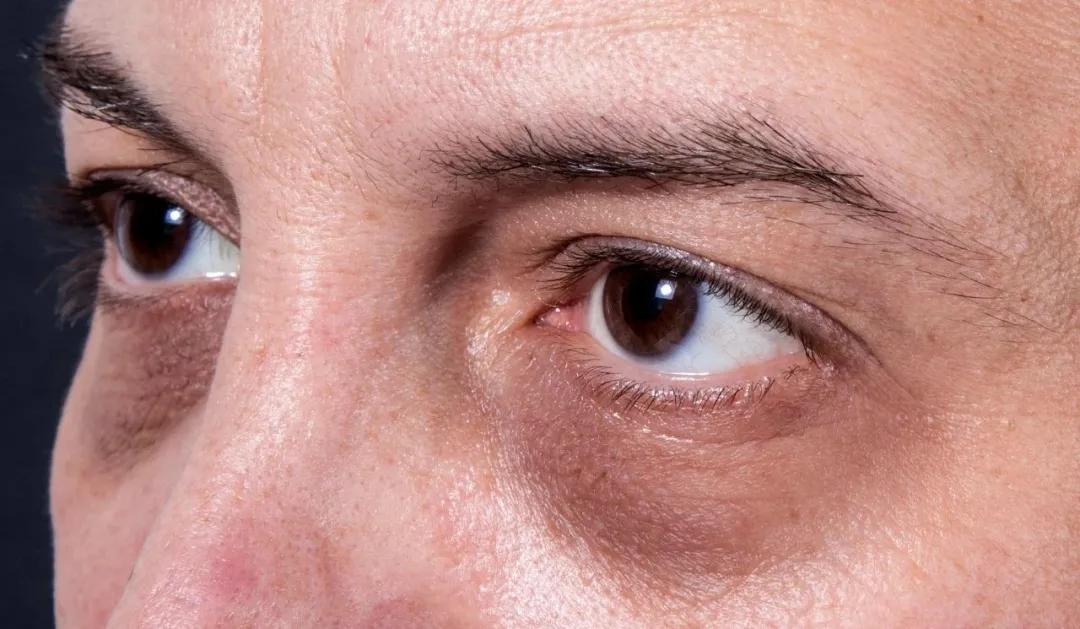 失眠能治好吗治疗失眠的小偏方,失眠能治好吗算是精神慢性疾病吗