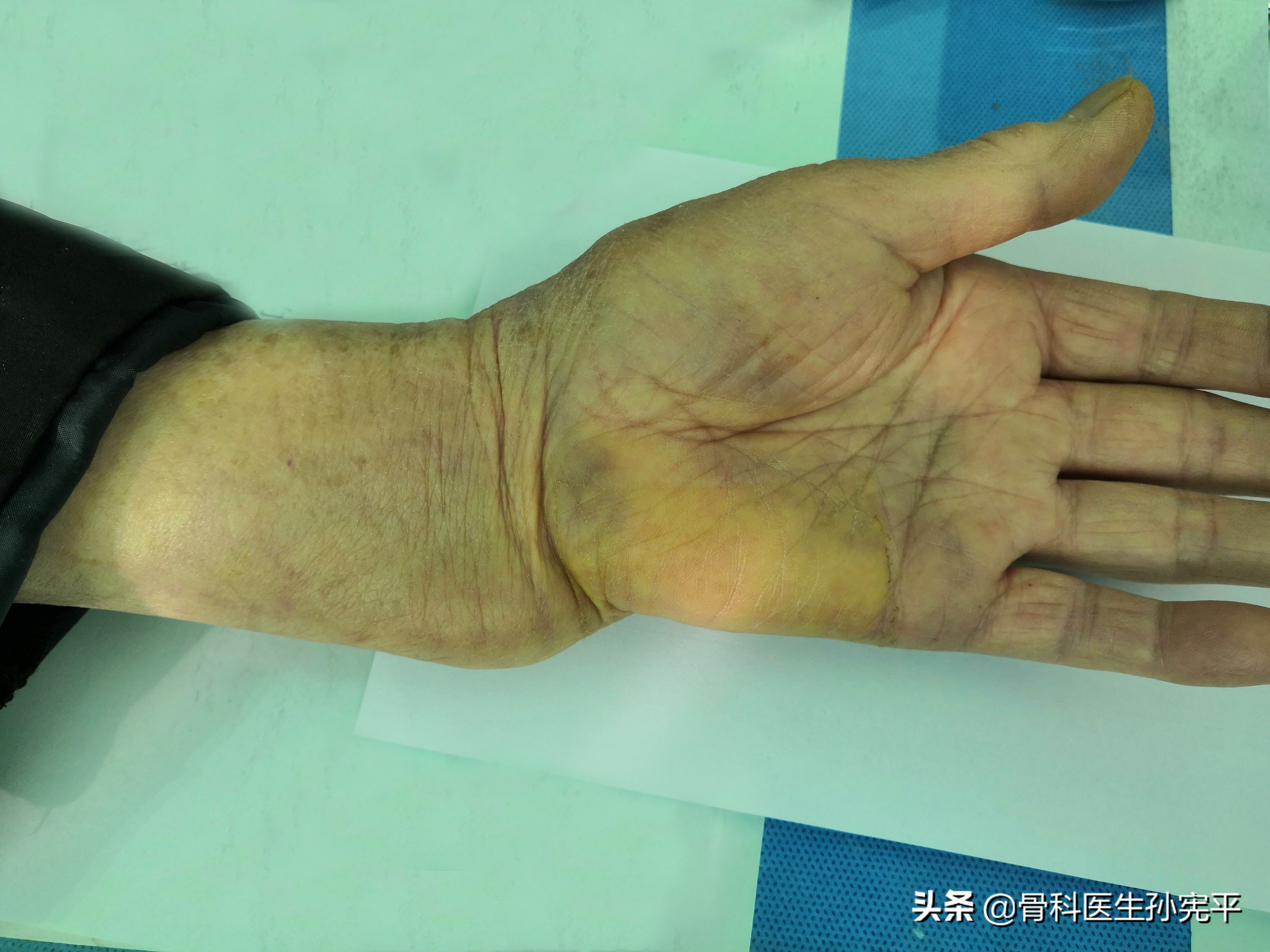 桡骨近端骨折和远端骨折哪个严重,桡骨远端骨折属于colles骨折吗