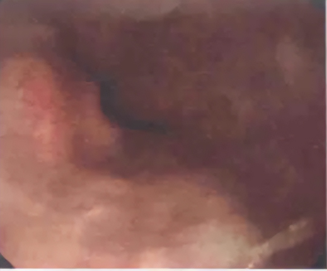 急诊PCI指南,急诊pci治疗费用