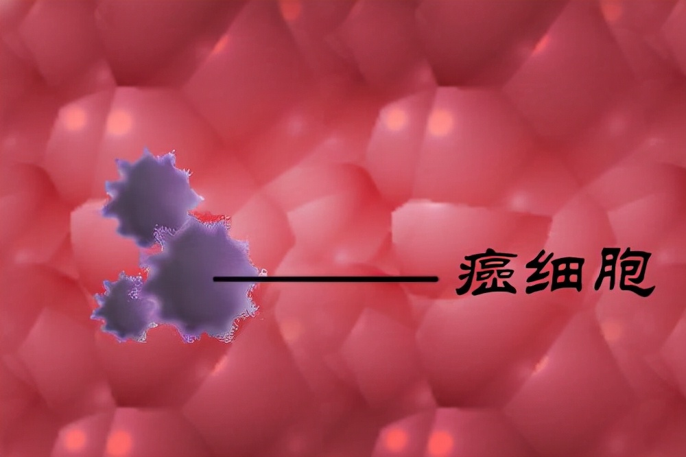 癌症多久不复发,癌症五年不复发算痊愈吗