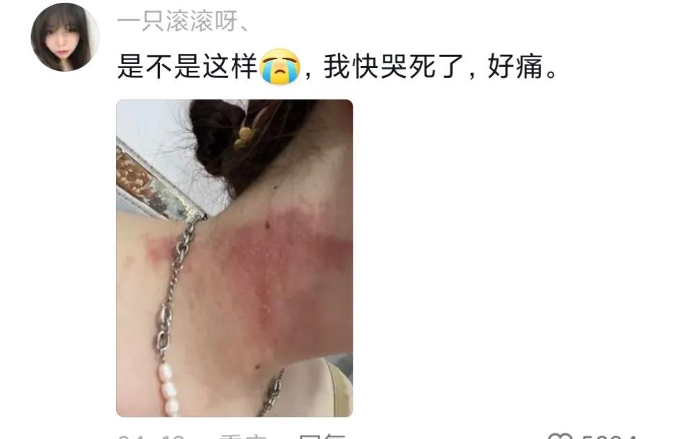 被隐翅虫毁容会好吗,隐翅虫脸上毁容