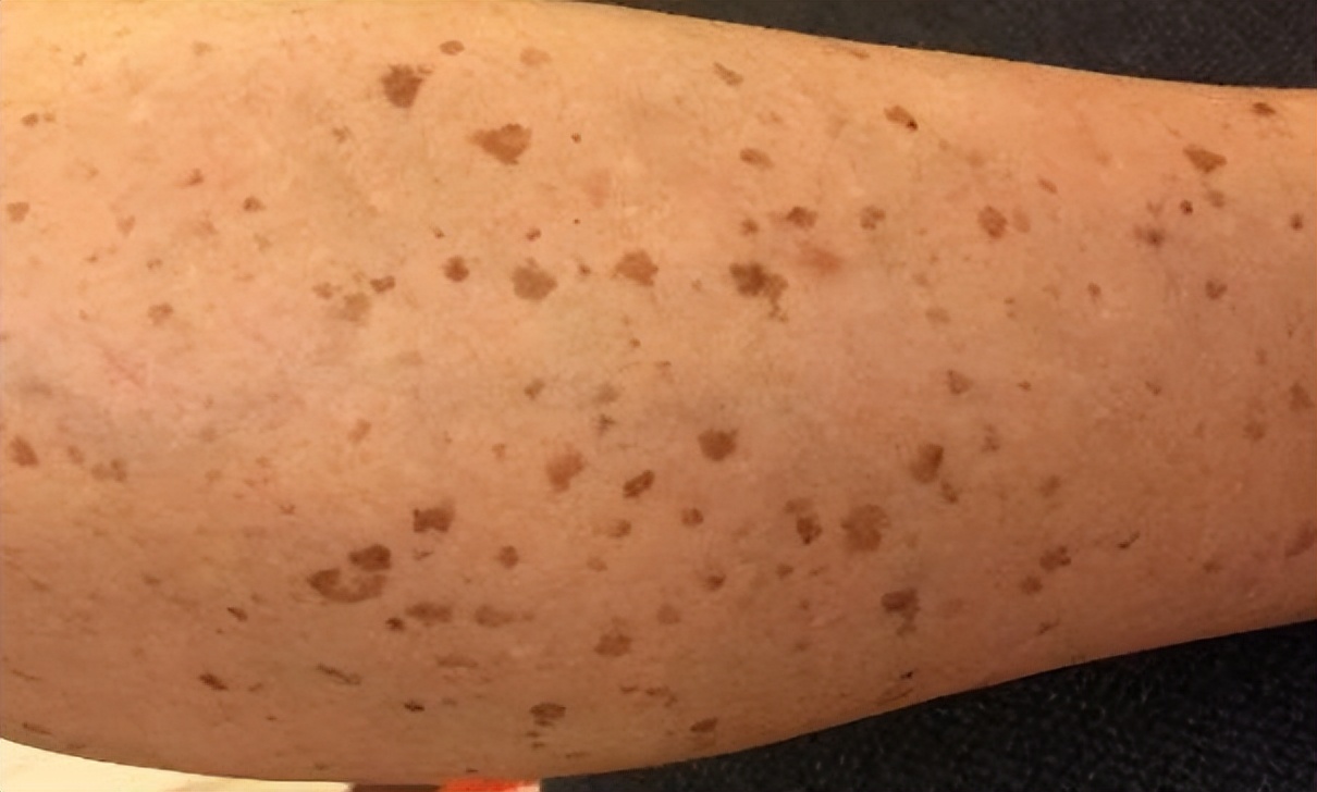 什么药膏去老人斑最有效,红霉素软膏能祛老人斑吗