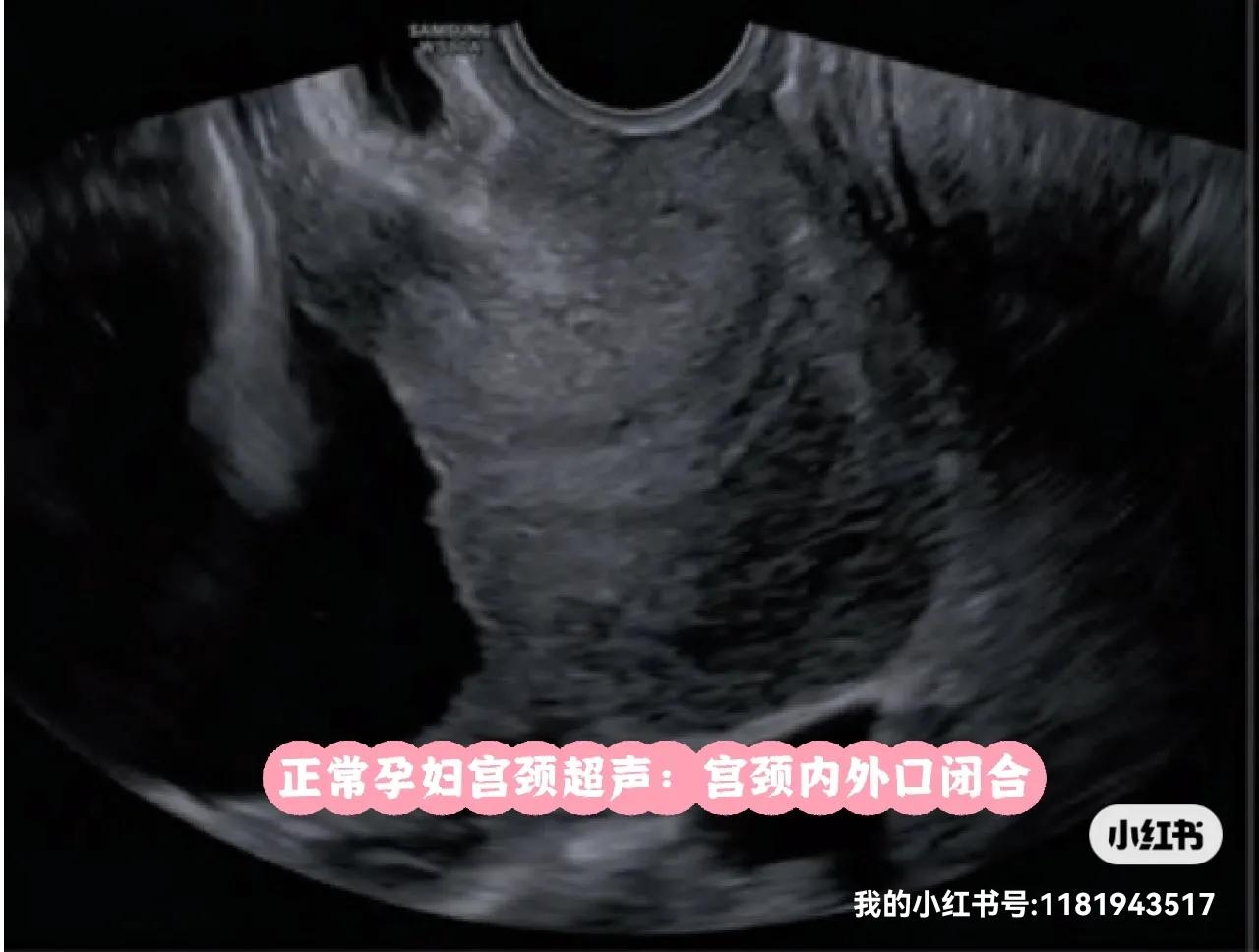 女神节特辑之什么是宫颈机能不全