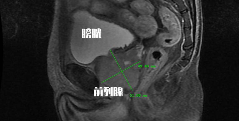 psa指标高已经一年还是降不下来,psa指数高可以吃药降下来不