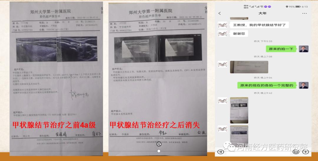 甲状腺结节乳腺增生经方案例,王付教授谈结节