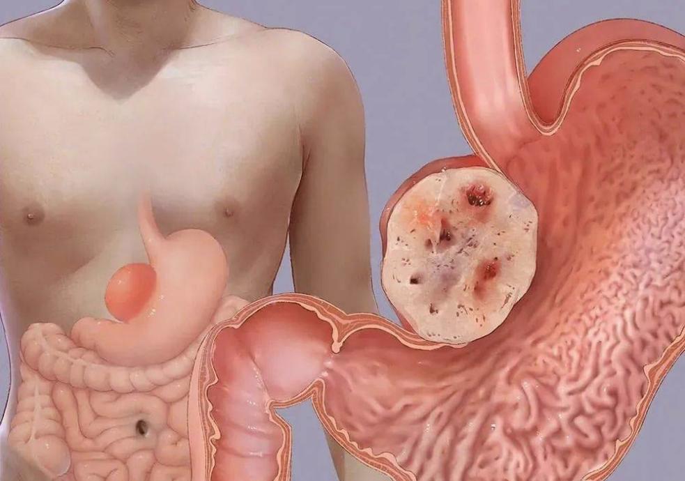 胃肠间质瘤属于肠癌吗,胃肠间质瘤会遗传吗