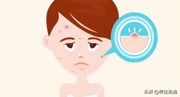 长痘可以吃辛辣食物吗,青春痘吃辛辣的会有影响吗