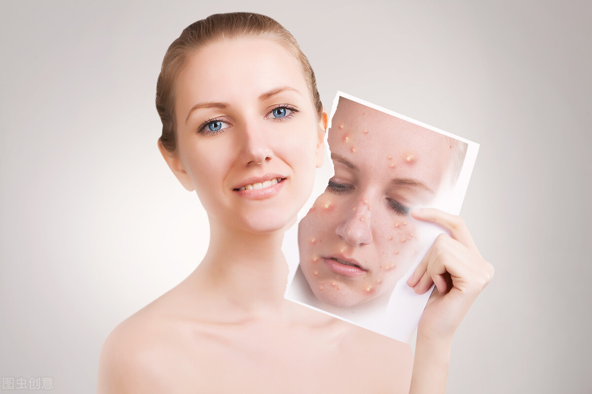 为什么脸上会长青春痘,少年脸上长了好多青春痘怎么办