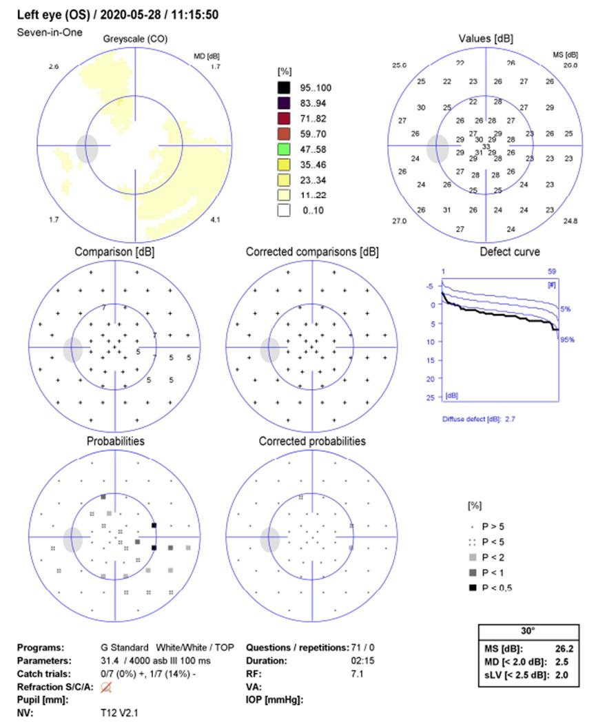 分享配眼镜案例,分享配眼镜的小知识