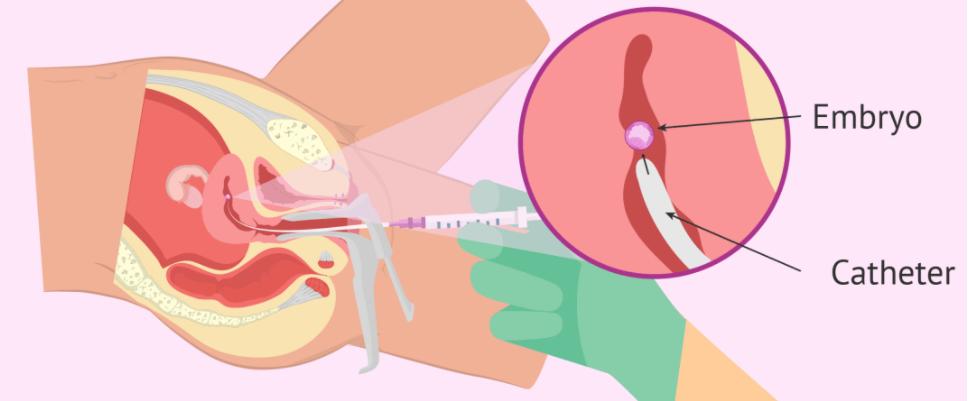 体外胎儿培育技术,体外培育婴儿