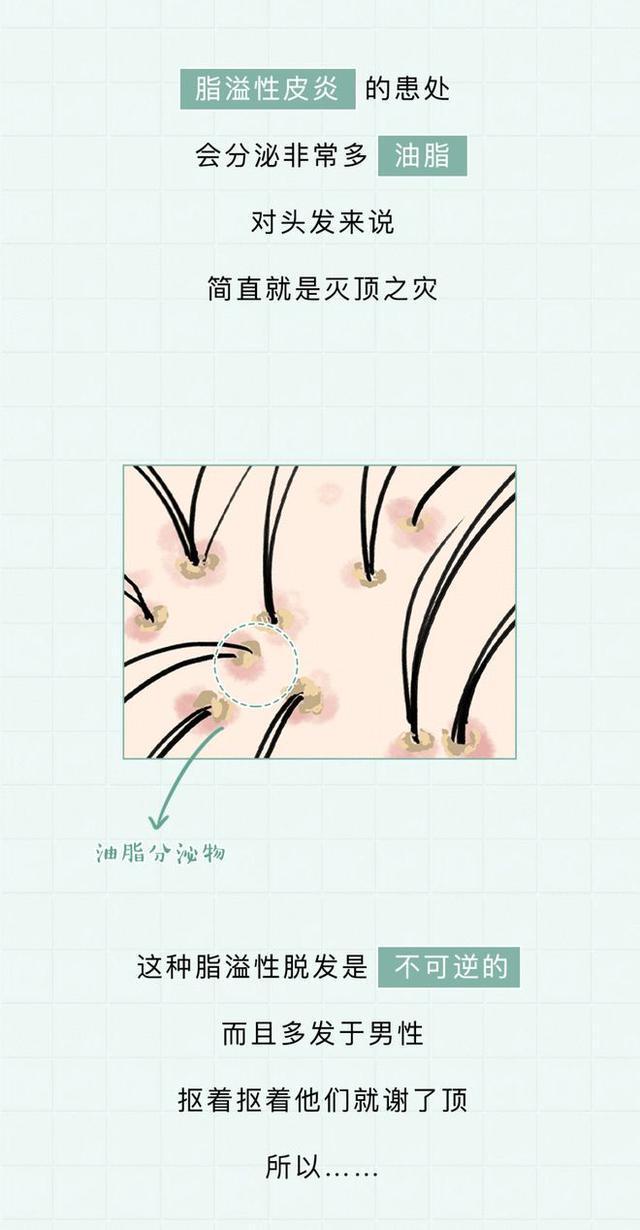 头皮内抠出白色颗粒状东西是什么,头皮上白色的小颗粒可以抠下来