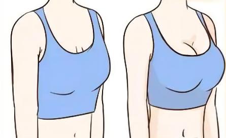 假体隆胸都有哪些副作用,假体手感怎么样