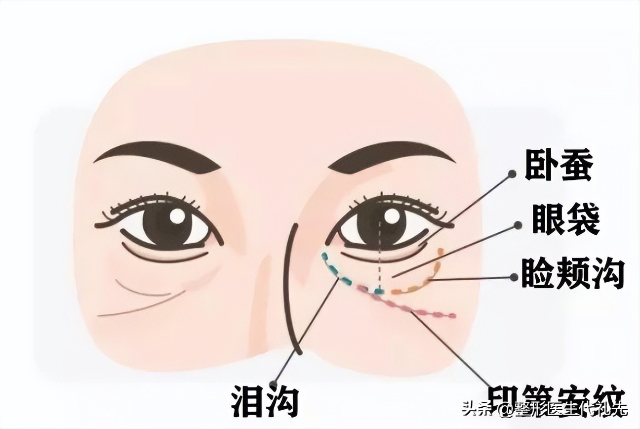 印第安纹形成的原因，印第安纹怎么去除效果最好？