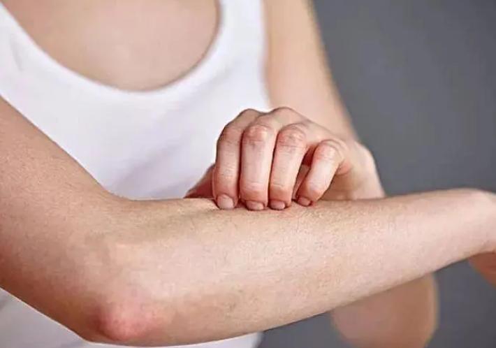 冬季皮肤皮屑满天飞,冬天来了皮肤干燥脱衣服有皮屑